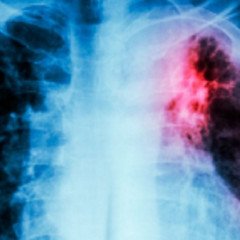 En 2025 se notificaron 884 casos de tuberculosis en Salta