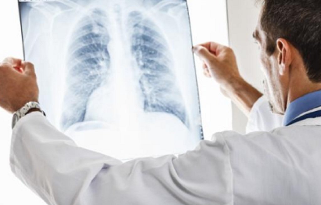 Confirman cerca de 9 mil casos de neumonía en Salta