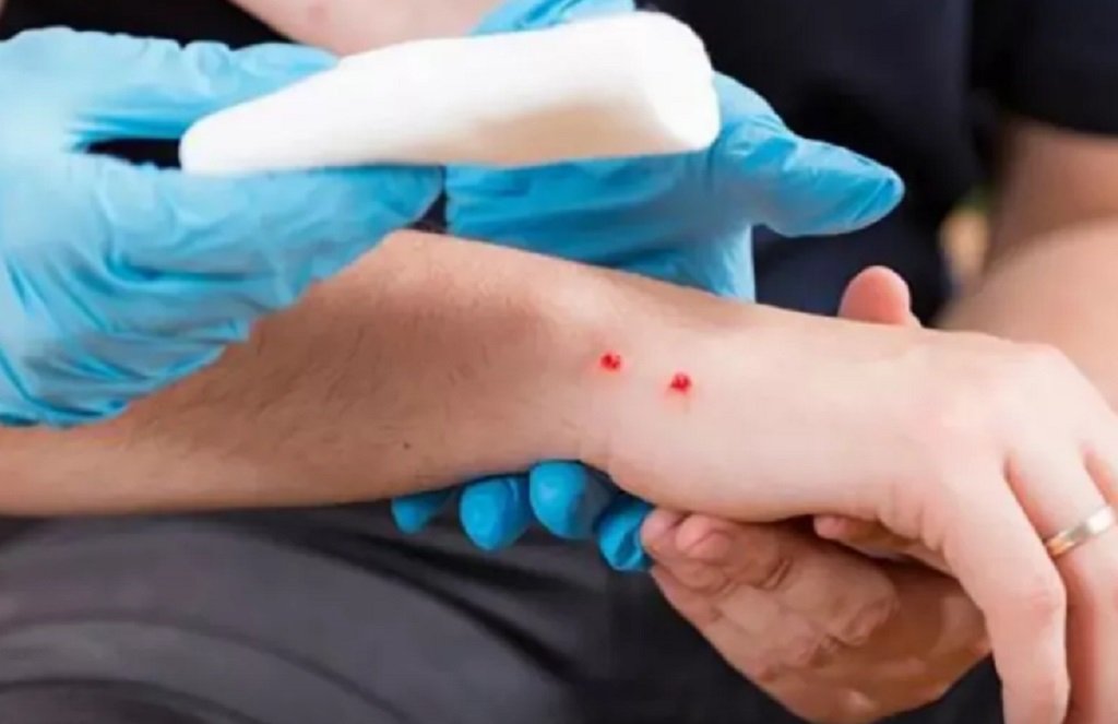 Salta ya registró más de 70 casos de mordeduras de víbora