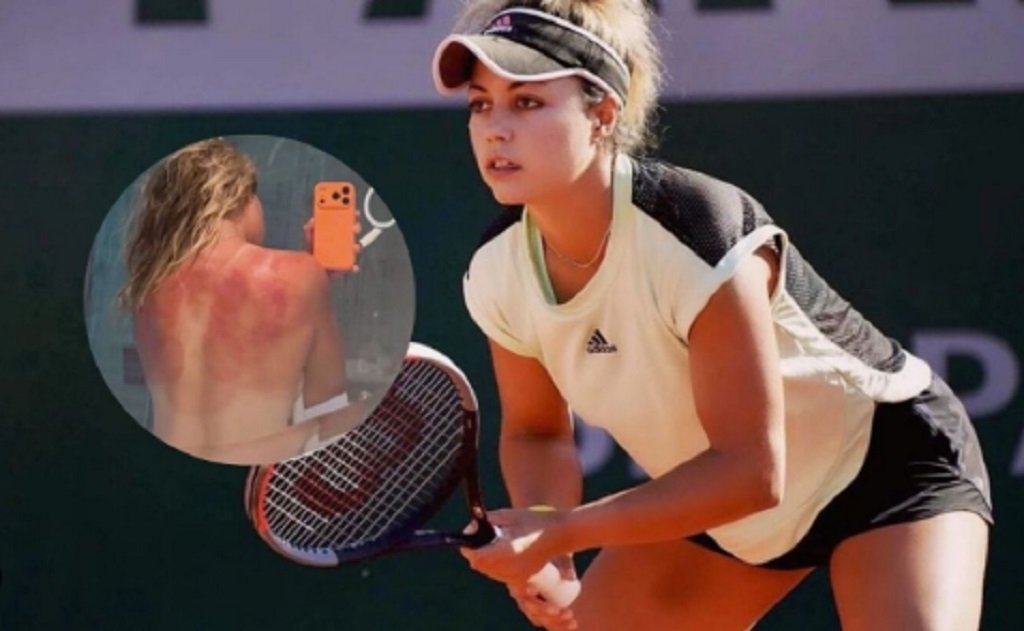 Tenista exhibió quemaduras por el sol