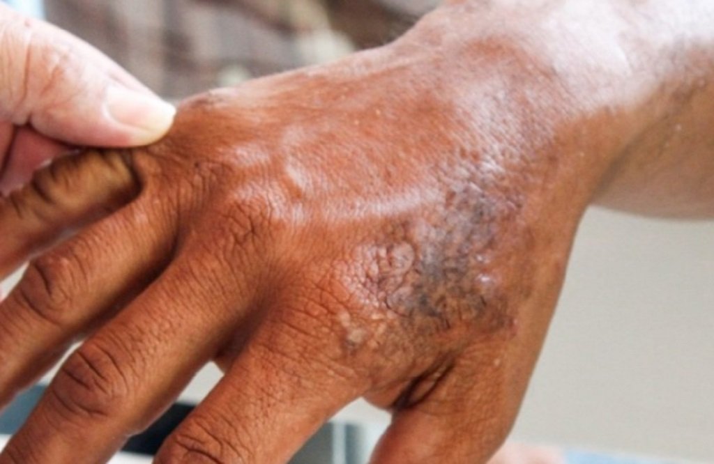 Salta registra 11 casos de lepra